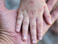 «Συναγερμός» για την ιλαρά από ΠΟΥ και C...