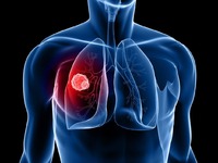 Ο ...ύπουλος καρκίνος του πνεύμονα- Τι π...