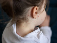 Δεύτερο παιδί πεθαίνει από ιλαρά στις ΗΠΑ