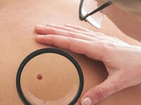 Όλα όσα πρέπει να ξέρετε για το μελάνωμα...