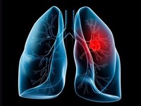 Εκτός του τσιγάρου τι άλλο ευθύνεται για...