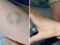 Διευθύντρια σχολείου δάγκωσε 11χρονο μαθ...