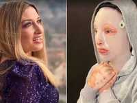 Επίθεση με βιτριόλι: η Ιωάννα και οι φωτ...