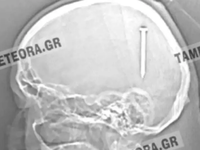 Καρφί 5 εκατοστών σφηνώθηκε στο κεφάλι άνδρα