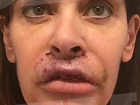 Ελληνίδα συγγραφέας είδε τα χείλη της να...