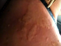 Μωβ Μέδουσα: «Με τσίμπησε και ήταν λες κ...