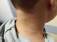 Πάτρα: Μαθητής στο νοσοκομείο από αλλεργ...