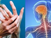 Την Τετάρτη η εκδήλωση για σκλήρυνση κατ...