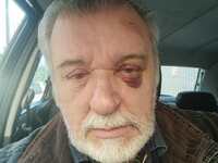 O Τάσος Χαλκιάς με μελανιασμένο μάτι – «...