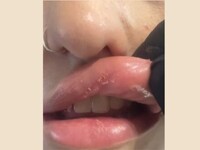 Έβαλε υαλουρονικό σε… νυχάδικο και παραμ...