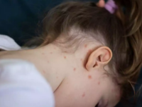 Συναγερμός για την ιλαρά στην Ευρώπη - Δ...