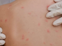 Αύξηση κρουσμάτων ιλαράς και ερυθράς στη...