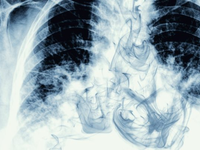 Τι κάνει το άτμισμα στους πνεύμονες