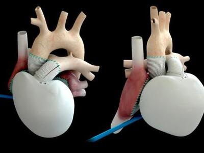 Η πρώτη εμφύτευση βιοπροσθετικής αυτόνομ...