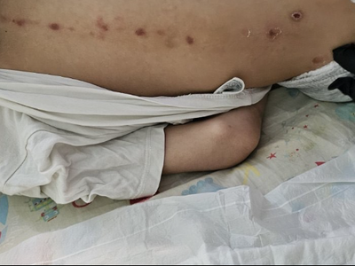 Πάτρα: Ερωτηματικά για τα σημάδια στο σώ...