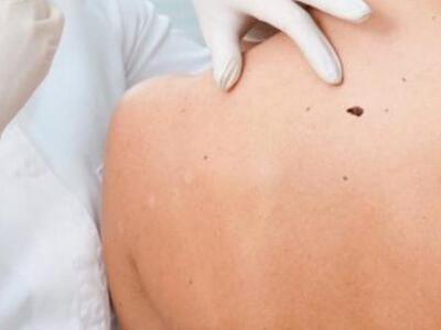 Δωρεάν εξετάσεις για καρκίνο του δέρματο...