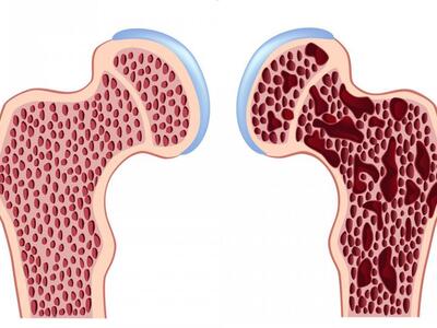 5.000 δωρεάν ακτινογραφίες οστεοπόρωσης ...