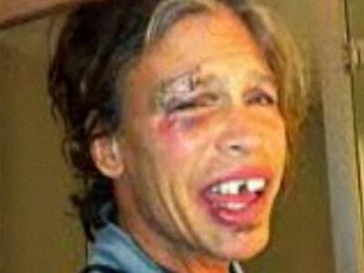 Σοκ: Δείτε τον Steven Tyler μετά το ατύχημα 