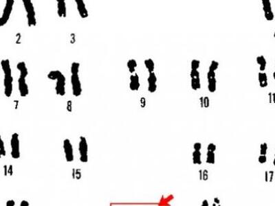 Πρώτο βήμα στην αντιμετώπιση του συνδρόμου Ντάουν;