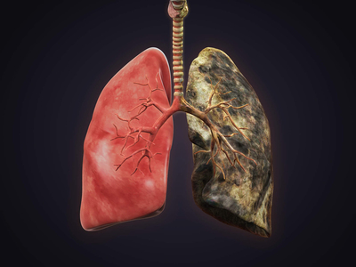 Καρκίνος του πνεύμονα: Μάθετε για τις σύ...