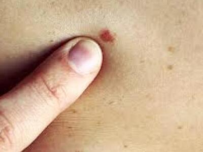 Ιατροκοινωνική εκδήλωση για το μελάνωμα ...