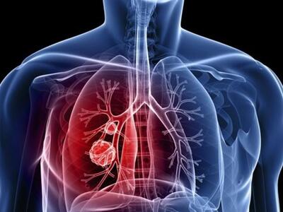 Πάτρα: Ημερίδα για την πρόληψη του καρκί...