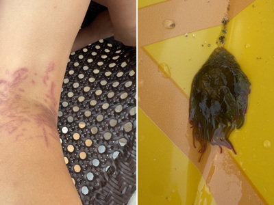 Τσίμπημα θαλάσσιας ανεμώνης έστειλε 6χρο...