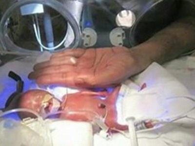 Γεννήθηκε 270 γραμμάρια και κατάφερε να ...