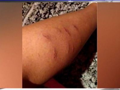 Αγέλη σκυλιών επιτέθηκε σε κοριτσάκι – Κ...