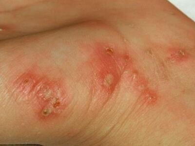 Ψώρα στο δέρμα: Συμπτώματα και θεραπεία