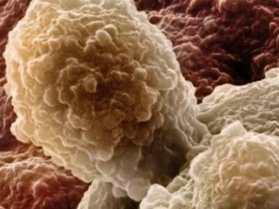 Σεξουαλικά μεταδιδόμενος ο καρκίνος του προστάτη;