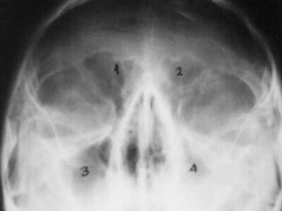 Φοιτητής έπεσε από ταράτσα και χτύπησε στο κεφάλι 