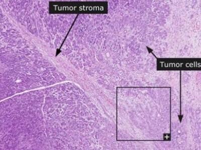 Ανοίγει ο δρόμος για την έγκαιρη διάγνωσ...