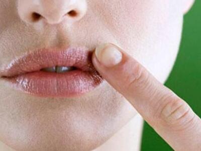 Πως να αποφύγετε τον επιχείλιο έρπητα