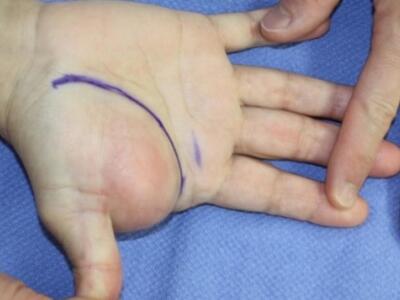 Λιπώματα: Γιατί δημιουργούνται, πότε πρέ...