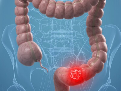 Πάτρα: Ενημερωτική Ημερίδα για τον καρκί...