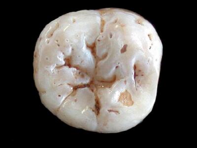 Νεαροί εθελοντές βρήκαν δόντι ανθρώπου π...