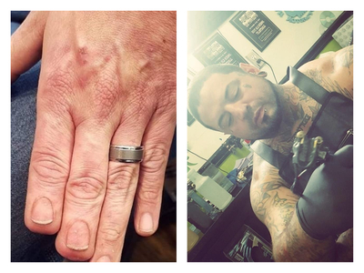 Έκανε τατουάζ στα ακρωτηριασμένα δάχτυλα...