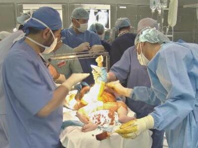 Επιστήμονες "ξεχώρισαν" σιαμαία