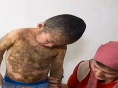 Σοκάρει το 5χρονο αγοράκι με δέρμα... ''σαύρας''