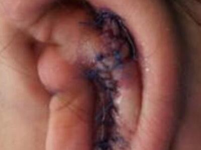 Πρωτοποριακή επέμβαση στην Κύπρο σε 14χρ...