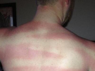 Δεν έβαλαν αντιηλιακό και δείτε τι έπαθαν... ΦΩΤΟ 