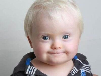 Πέντε μεγάλες αλήθειες για το σύνδρομο Down