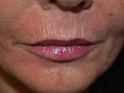 Το αισθητό αποτέλεσμα μείωσης ρυτίδων με...