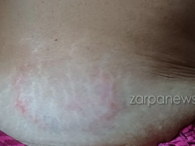 Χανιά: Θαλάσσια χελώνα δάγκωσε γυναίκα στα ρηχά