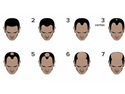 Ταξινόμηση κατά Norwood/Hamilton