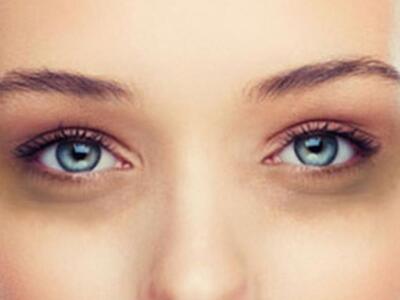 Μαύροι κύκλοι στα μάτια; Αυτές είναι οι ...