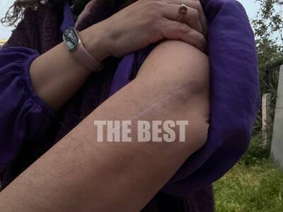 Τα σημάδια της χειρουργικής επέμβασης στ...