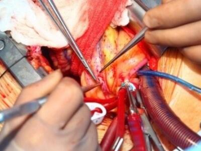 Το Botox προλαμβάνει την κολπική μαρμαρυ...