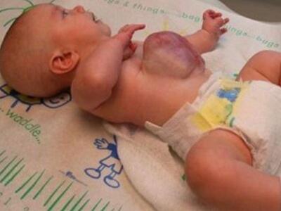 Μωρό γεννήθηκε με τα όργανα έξω από το σώμα του!